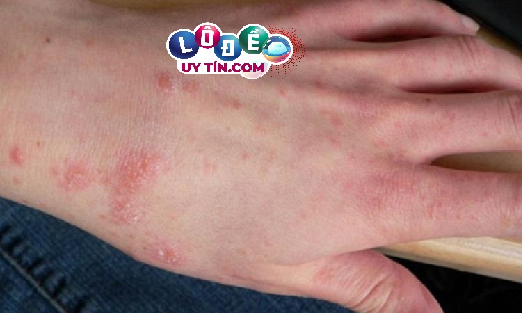 Nằm mơ thấy bị ghẻ lở là điềm gì? Đánh số nào? 12 Nằm mơ thấy bị ghẻ lở là điềm gì? Đánh số nào?