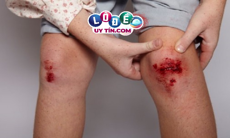 Điềm báo mơ thấy chảy máu chân đánh con gì? Có ý nghĩa gì? 26 Điềm báo mơ thấy chảy máu chân đánh con gì? Có ý nghĩa gì?