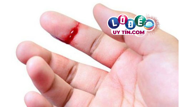 Mơ bị chặt ngón tay đánh con gì? Giải mã giấc mơ 26 Mơ bị chặt ngón tay đánh con gì? Giải mã giấc mơ