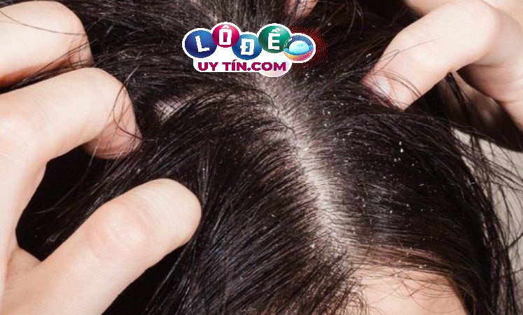 Giải mã giấc mơ: Nằm mơ thấy con chấy đánh con gì dễ ăn? 18 Giải mã giấc mơ: Nằm mơ thấy con chấy đánh con gì dễ ăn?