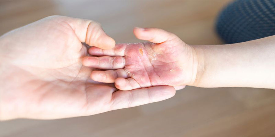 Nằm mơ thấy bị bỏng đánh lô như thế nào cho hợp lý? 23 Nằm mơ thấy bị bỏng đánh lô như thế nào cho hợp lý?